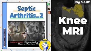 Fig 5E02 Bone Erosions in Pyogenic Arthritis [upl. by Stanley]