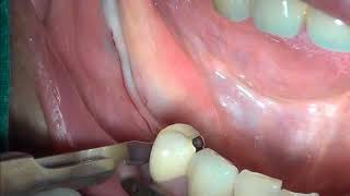 Apical repostioned flap [upl. by Ikram212]