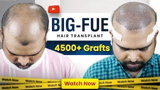 Hair Transplant in Hyderabad  Best Hair Transplant Cost and Hair Transplant Doctor in Hyderabad [upl. by Janka]