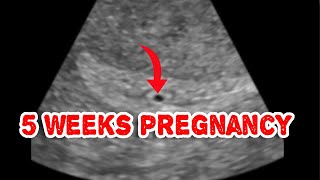 Early pregnancy sac on ultrasound Intradecidual sac sign [upl. by Ahsiuqel435]