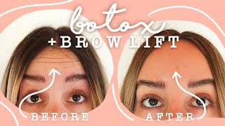 Getting Botox  Brow Lift  Before amp After VLOG [upl. by Ainwat70]