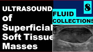 Fluid collections on Ultrasound [upl. by Coopersmith]