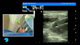 Laser Ablation of benign thyroid nodules [upl. by Whitehouse]