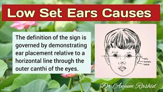 Low Set Ears Causes and Associated Anomalies  Pediatrics [upl. by Clementis]