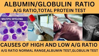 ALBUMIN TO GLOBULIN RATIOAG RATIO TESTHIGH AND LOW AG RATIOAG RATIO INLIVER AND KIDNEY PROBLEM [upl. by Riggall]