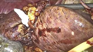 Central hepatectomy HCC [upl. by Eceinahs]