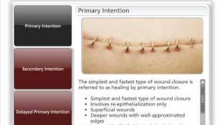 Types of Wound Closure [upl. by Kono319]