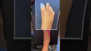 HALLUX VARUS CORRECTION USING MINIMALLY INVASIVE TECHNIQUE🦶🏼shorts halluxvarus [upl. by Cassell]