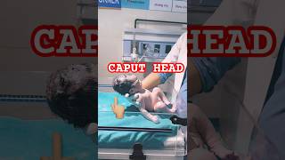 Newborn baby with caput headbaby vlogviral [upl. by Solenne]