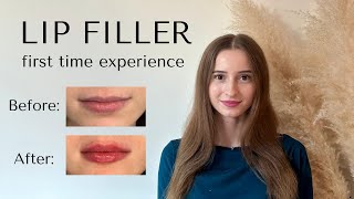 Getting Lip Filler for the First Time [upl. by Croix]