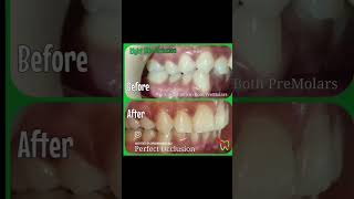 See What Braces Can Do  • Crowding  Unilateral CrossBite  Crooked Teeth  Correction with Braces [upl. by Hueston]