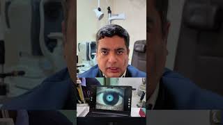 Dry Eyes Heres Why We Test Before LASIK 💧Part 44 lasiksurgeon lasiksurgeongurgaon [upl. by Adamsen]