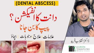 DENTAL ABSCESS  PUS in Teeth  GUM Swelling  دانتوں میں پیپ کا بننا  Urdu  InqalabFareed [upl. by Jabez951]