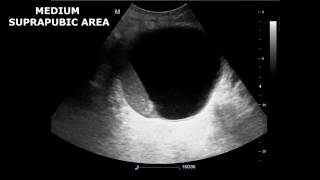 Renal Ultrasound in Etiology of Acute Kidney Failure  A Case Report [upl. by Phyllis821]