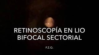 Retinoscopía con LIO bifocal sectorial [upl. by Anitsugua798]