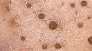 Blackheads amp Whiteheads Satisfying Removal 0116 [upl. by Haland985]