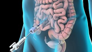 Laparoscopic Lysis of Abdominal Adhesions 2011 [upl. by Ativad]