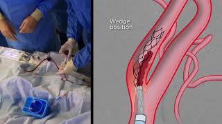 Extracranial Thrombectomy with eSAVE [upl. by Vevine]