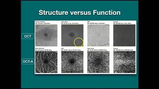 OCT Angiography with Graham Lakkis BScOptom [upl. by Jeanne665]