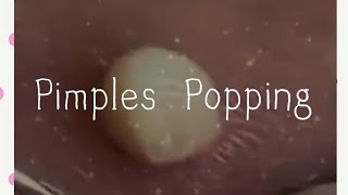 Pimples amp Blackheads Popping  59 [upl. by Cherian]