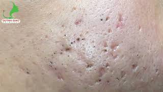 Satisfying SkinCare Blackheads Acne Extraction Video With Dr Thuy QGSPA Date Nov122024 1 [upl. by Ayom996]