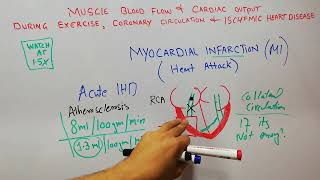 CVS 201  Myocardial infarction  Subendocardial infarction  Heart attack [upl. by Kaufman]