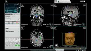 United Imaging Diffusion Tensor Imaging Post Processing [upl. by Harald]