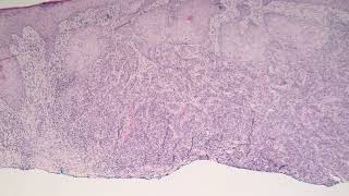 Squamous Cell Carcinoma Moderately Differentiated [upl. by Hazlett]