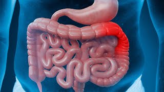 Inflammatory bowel disease  Ulcerative colitis  Weird symptoms amp treatment [upl. by Ingrid997]