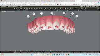 Invisalign  step by step guide [upl. by Badger]