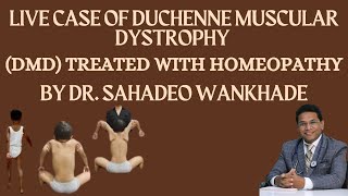 quotLive Case of Duchenne Muscular Dystrophy DMD Treated with Homeopathy BY DR SAHADEO WANKHADE [upl. by Huberty993]