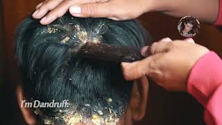 Dandruff Removal Long Hair Guys 57 [upl. by Connell]