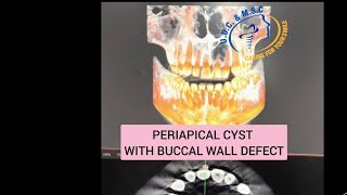 Periapical cyst with BUCCAL WALL DEFECT [upl. by Jeggar448]