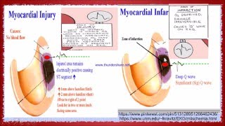 ST segment changes in Myocardial infraction [upl. by Khudari155]