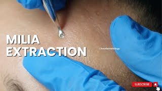 MILIA EXTRACTION ON THE FOREHEAD [upl. by Sairtemed963]