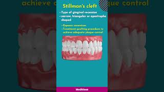 Changes in gingival contour stillmans cleft McCall festoon [upl. by Dewain523]