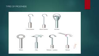 Otosclerosis Department of ENT  Santhiram Medical College [upl. by Atilrep]