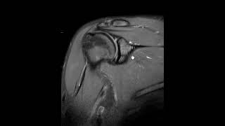 How does a post arthrogram MRI shoulder compare to a non contrast MRI for labral tear [upl. by Eremaj]