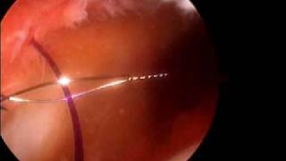 Arthroscopic Medial patella plication Dr A Reznik [upl. by Paryavi]