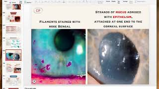 Non infective keratitis [upl. by Llirret]