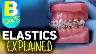 Braces Elastics Explained shorts [upl. by Genny]