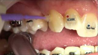 Orthodontic Brace Fitting West London Orthodontist Dr Chaw Su Kyi [upl. by Bea671]