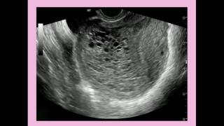 Molar Pregnancy Hydatidiform Mole Gestational Trophoblastic Disease Obstetrics amp Gynaecology [upl. by Audwin]