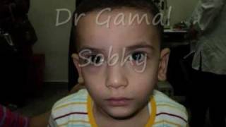 الحول الوحشي المتقطع  Intermittent Exotropia [upl. by Zandt]