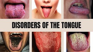 Tongue Diseases Geographic Tongue Black Hairy Tongue Glossitis Thrush and Leukoplakia [upl. by Kylen]