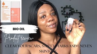 Bio oil product review  for uneven skin tone scars and stretch marks [upl. by Knarf]