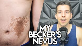 My Beckers Nevus Birthmark [upl. by Klepac]