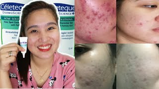 SOLUSYON SA PIMPLES CELETEQUE ACNE CORRECTOR GEL REVIEW [upl. by Lolita]