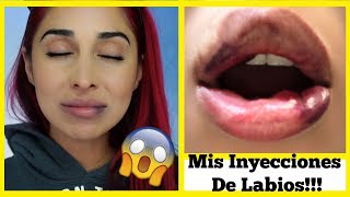 INYECCIONES DE LABIOS CON ACIDO HIALURONICO JUVEDERM LIP INJECCIONS [upl. by Koerner]