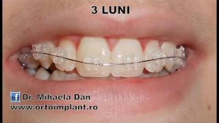 Aparat dentar fix safir  dinti drepti in 6 luni [upl. by Lefkowitz]